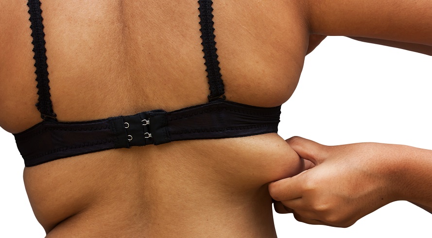 Bra Bulge and Back Fat Liposuction  Liposuction and Treatment in St. Louis