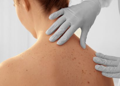 mole inspection as part of skin cancer treatment